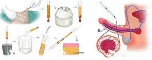 脂肪填充增粗动画演示图 脂肪填充增粗动画演示图