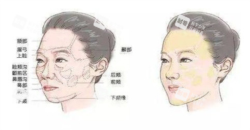 胶原蛋白面部填充前后
