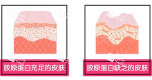 胶原蛋白填充的皮肤对比
