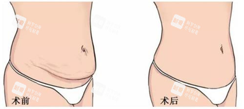 美人鱼腹壁成形手术前后的区别