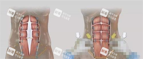 美人鱼腹壁成形术的过程