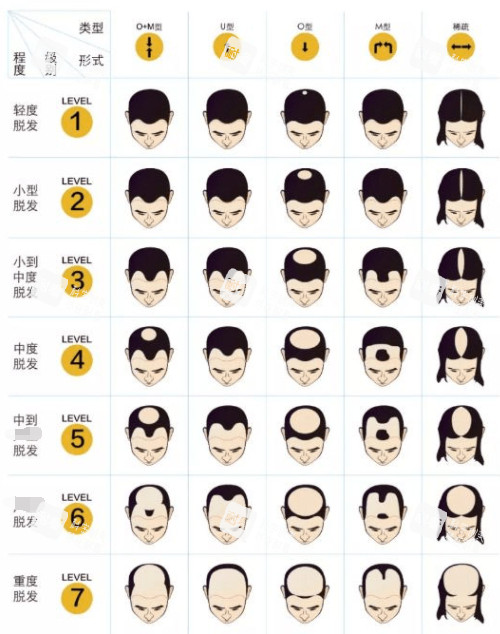 黑米3d纹发不同脱发类型