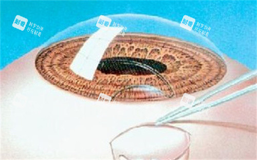 屈光手术示意图 屈光手术示意图