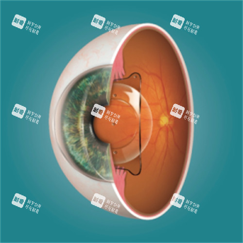 ICL晶体植入动画图 ICL晶体植入动画图