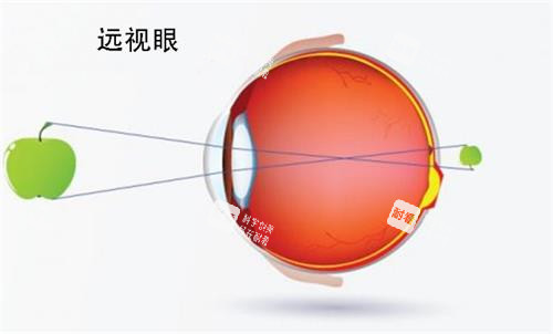 远视眼睛的视力
