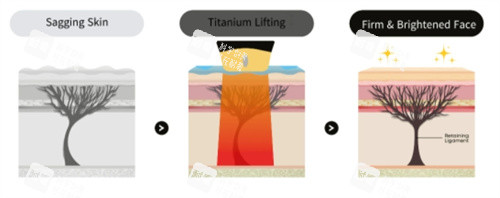 钛提升三种模式层次 钛提升三种模式层次