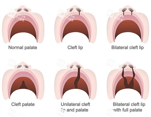 唇裂修复类型 唇裂修复类型