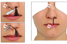 唇裂修复图示 唇裂修复图示