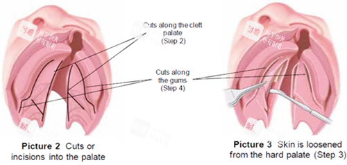 唇裂修复图片一览