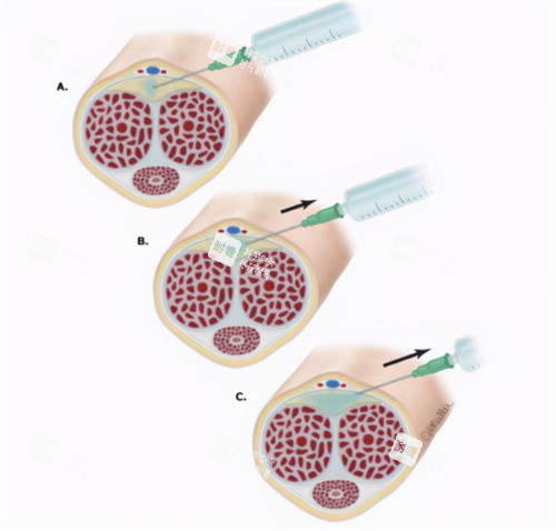 注射增粗动画演示图