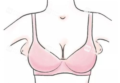 副乳位置卡通示意图