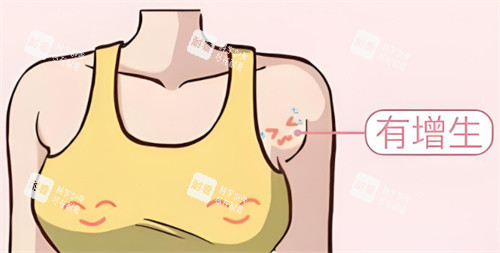 手术去副乳部位