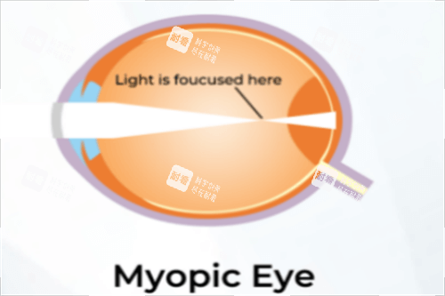 近视示意图 近视示意图