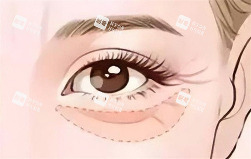 眼部填充胶原蛋白 眼部填充胶原蛋白