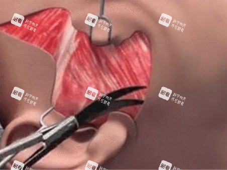 拉皮手术动画图