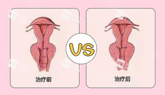 阴道紧缩针前后对比 阴道紧缩针前后对比