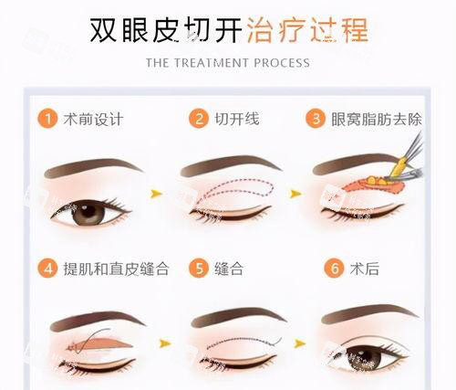 双眼皮手术方法过程图 双眼皮手术方法过程图