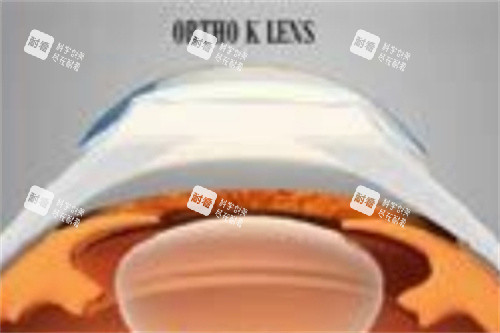 角膜塑形镜2 角膜塑形镜2