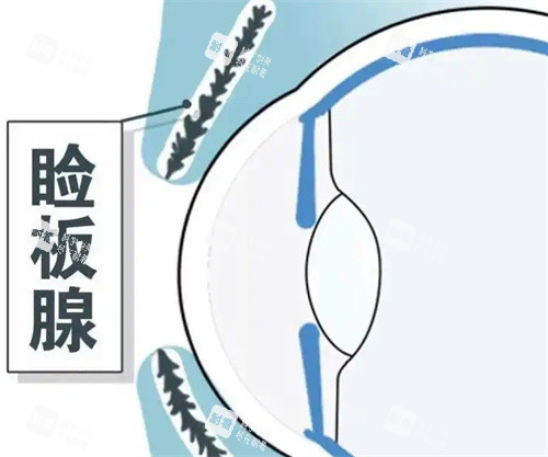 睑板腺示意图 睑板腺示意图