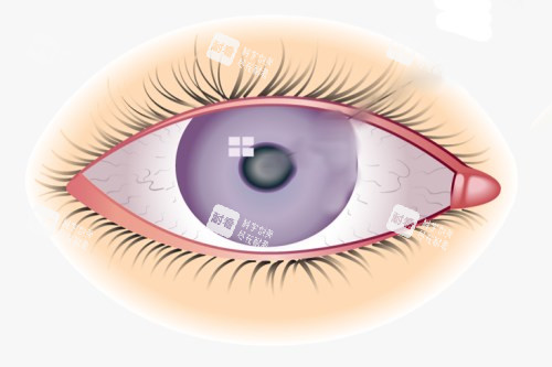 晶状体浑浊示意图