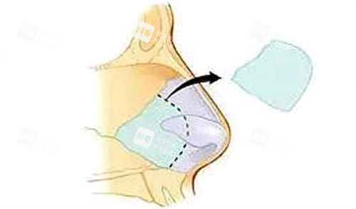 鼻中隔软骨隆鼻移除位置展示图