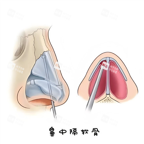 鼻中隔软骨演示动画图