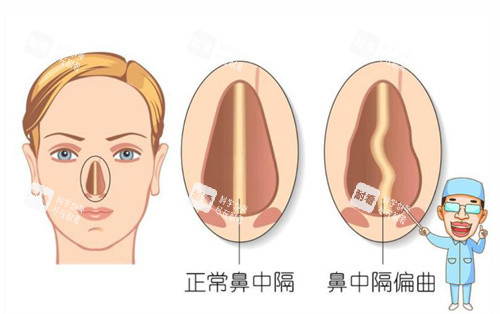 鼻中隔卡通展示图