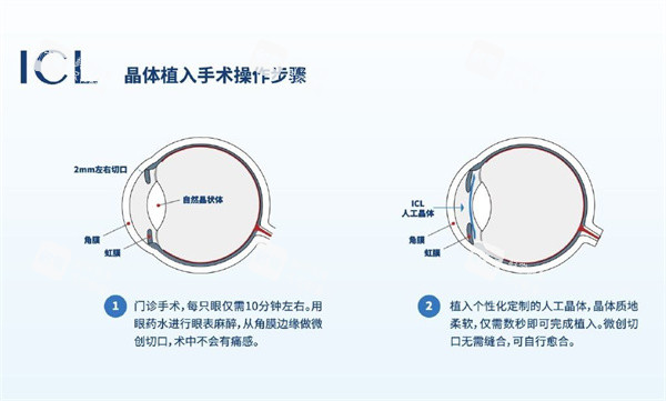 icl晶体植入解刨图