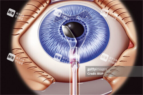 icl晶体植入手术