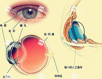 三焦点人工晶体植入手术示意图