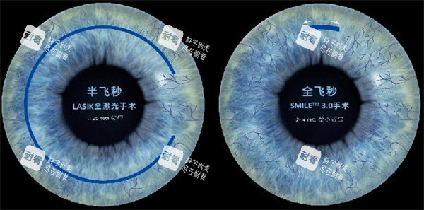 lasik和smile手术照片