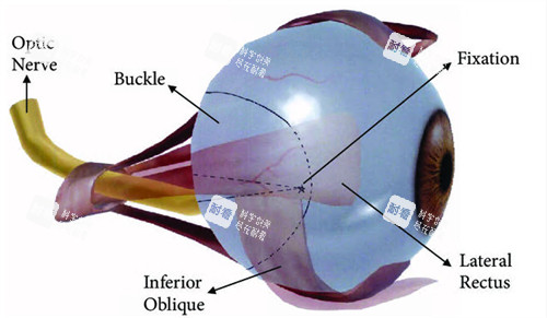 后巩膜加固术动画图