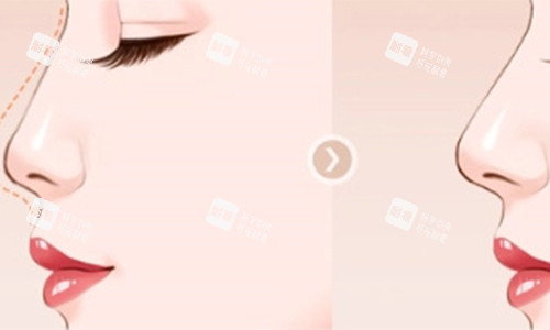 垫鼻子的前后对比动画图