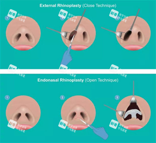 鼻整形过程图