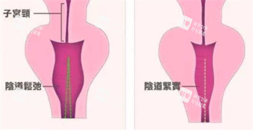 生物束带紧缩术对比