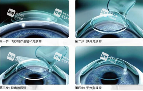 激光手术过程细节图 激光手术过程细节图