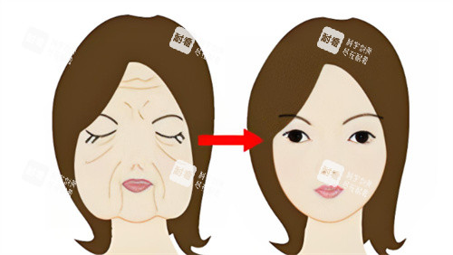 面部抗衰前后对比 面部抗衰前后对比