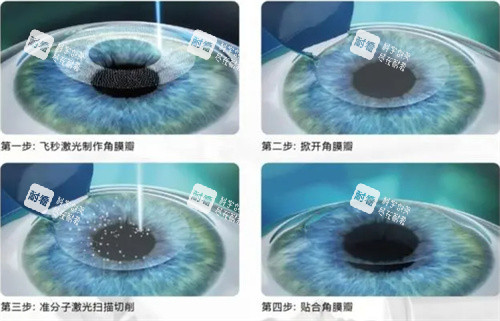 半飞秒手术图 半飞秒手术图