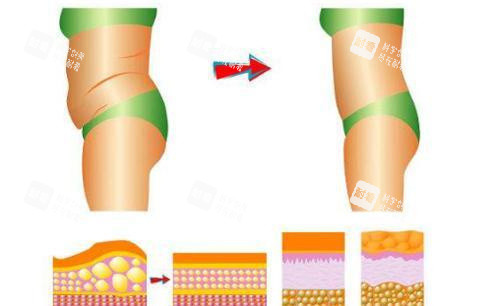 腰腹吸脂对比图 腰腹吸脂对比图