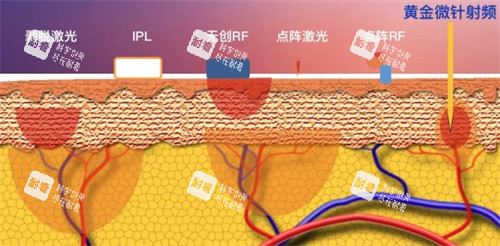 南京张让虎腰腹吸脂价格：9800起+150天瘦18cm真实病例