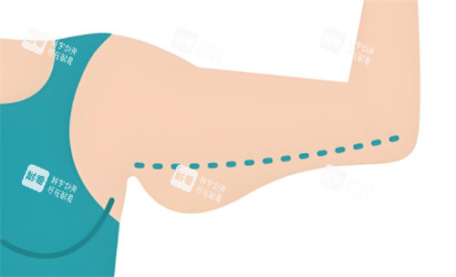 吸脂瘦手臂对比动画 吸脂瘦手臂对比动画