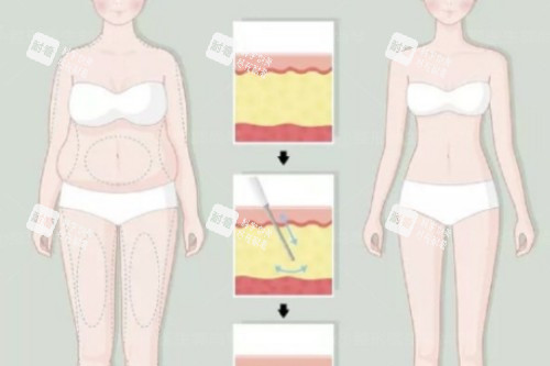 吸脂卡通前后对比图 吸脂卡通前后对比图
