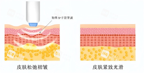 热玛吉作用对比