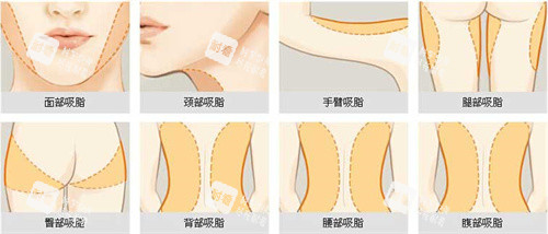 可以进行吸脂手术的部位展示动画图