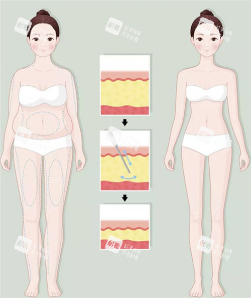 吸脂前后动画图示