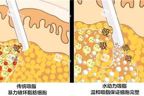 吸脂示意图