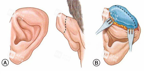 耳畸形矫正术 耳畸形矫正术