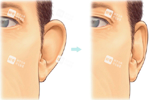耳畸形 耳畸形