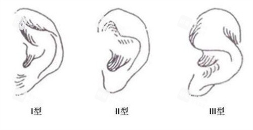 小耳畸形的类型 小耳畸形的类型