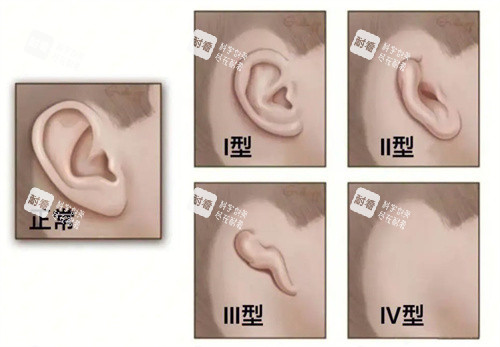 耳畸形的种类 耳畸形的种类